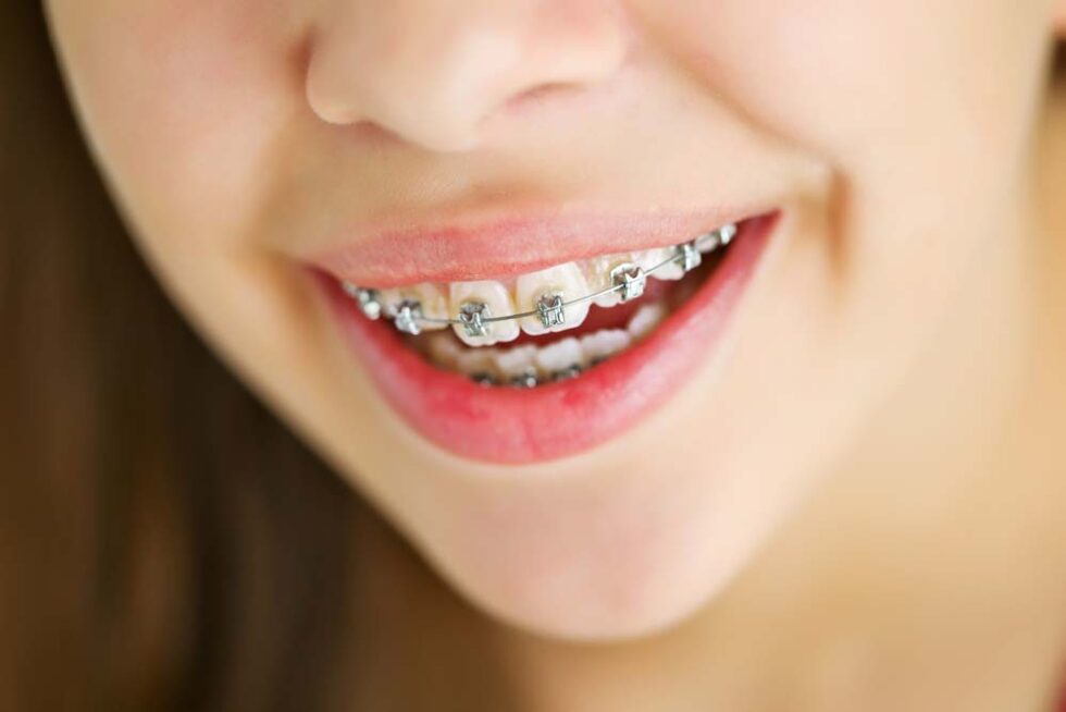 Braces for children Castle Orthodontics